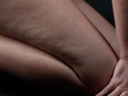 Une qui s’accroche : la cellulite